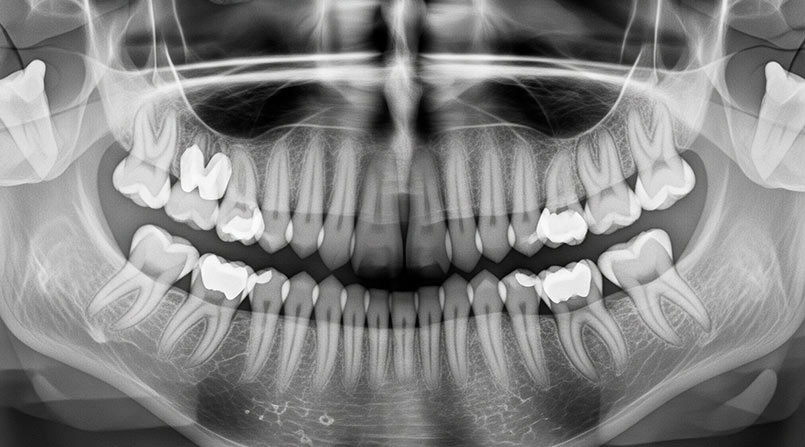 Raio X Panorâmico: tecnologia e precisão para o diagnóstico odontológico na Sore Radiologia